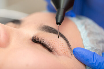 cosmetic procedure for lifting the skin of the eyelids of asian eyes. non-surgical blepharoplasty wi