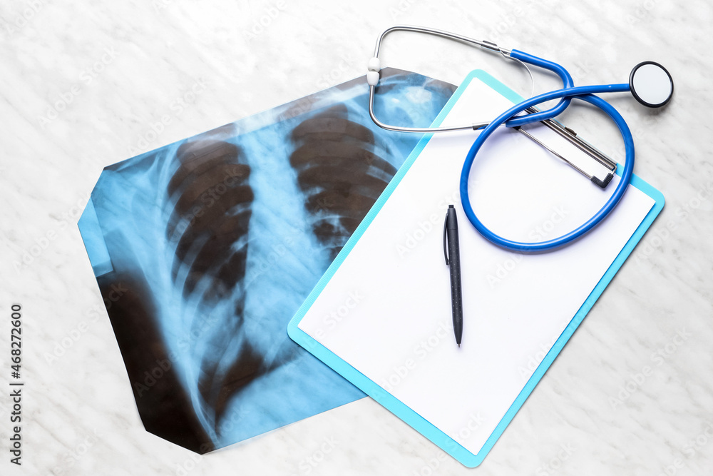 X-ray scan of lungs with clipboard and stethoscope on white background