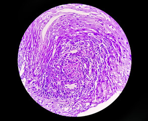 Poster - Adenocarcinoma of esophagus. Esophageal cancer or cancer of the food pipe.