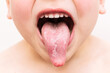 Geographic tongue disease. Cropped shot of a small child shows tongue with inflammatory lesions isolated on a white background