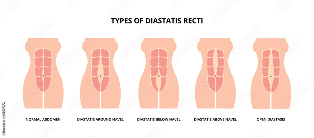 Split Belly Button Types of diastasis recti, also known as abdominal separation, common ...