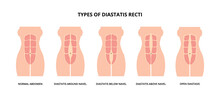 Types Of Diastasis Recti, Also Known As Abdominal Separation, Common Among Pregnant Women. Abdomen Muscles, Anatomy, Postpartum Care 