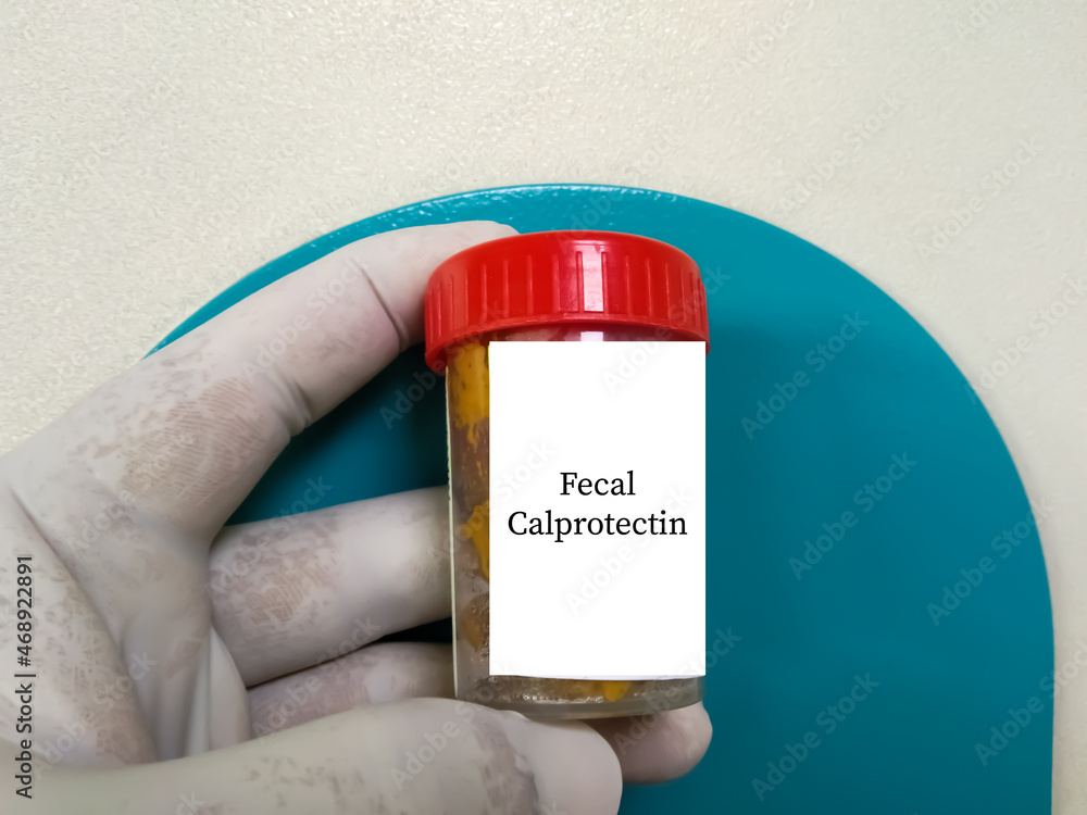 Doctor holding stool specimen jar for Faecal Calprotectin test. To