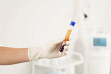Vacutainer With A Platelet-rich Plasma And Blood For PRP Treatment