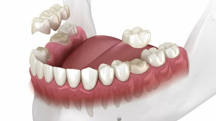 Wall Mural - Instalation of dental bridge and single crown. Medically accurate 3D animation