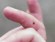 Tick season. Lyme disease - caused by tick bites.