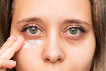 Wall Mural - Cropped shot of a young caucasian woman touching a skin of her face while applying the cream for black eyes. Bruises under the eyes are caused by fatigue, nervousness, lack of sleep, insomnia, stress