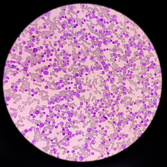 Poster - Blood cancer. Chronic myelogenous leukemia, also known as Chronic myeloid leukemia(CML) with Thrombocytosis.