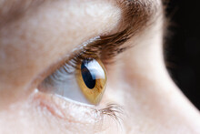 Macro Photo Of The Human Eye With Corneal Disease Keratoconus