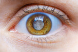 Fototapeta  - Human eye with clouded lens, white pupil, cataract macro