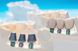 Close up Implant model tooth support fix bridge implant and crown.