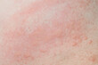 Allergic skin rash prickly heat skin red dot closeup skin problem itching