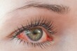 © Tunatura - Red irritated human eye close up, allergy symptom