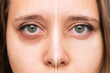 Cropped shot of a young female face. Close-up of female green eyes with Dark circles under eyes before and after cosmetic treatment. Bruises under the eyes.   Cosmetology concept