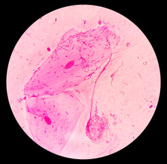 Canvas Print - Gram stain microscopic slide, plenty epithelial cells, few pus cells, diplococci and fungal hyphae, 40x view