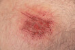 Close up of an abrasion wound in Caucasian skin