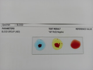 Poster - Blood group testing by slide agglutination method with report , AB Negative blood grouping. medical concept