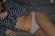 © Tatiana Timofeeva/Stocksy - consequences after peritonitis