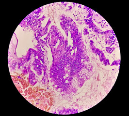 Sticker - Photomicrograph showing adenocarcinoma. cancer, oncology, histology. 40x