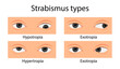 Types of strabismus. Hypotropia, hypertropia, exotropia, esotropia. cartoon style