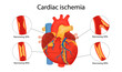 cardiac ischemia. anatomical illustration drawn in cartoon style
