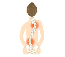 Illustration Of The Back Of A Woman With Scoliosis And A Bent Spine.