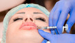 © Vera - Lip augmentation. Beautician injects hyaluronic acid into the lips of a girl with a syringe. The cosmetologist doctor performs the procedure in the cosmetology office. Plastic surgery.
