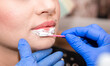 © Vera - Lip augmentation. Beautician injects hyaluronic acid into the lips of a girl with a syringe. The cosmetologist doctor performs the procedure in the cosmetology office. Plastic surgery.