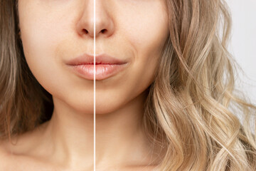 Wall Mural - Cropped shot of young caucasian blonde woman with wavy hair before and after plastic surgery buccal fat pad removal. A lower part of face with clear highlighted cheekbones. Result of cosmetic surgery