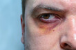 A man with a black eye, after a fight or an accident.Eye injury