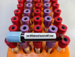 Blood sample for von Willebrand factor(vWF) antigen test, clotting factor disorder, coagulation test, focus view