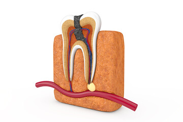 Poster - Inside of Decay Tooth. 3d Rendering