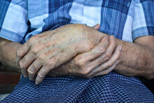 Age Spots On Hands. They Are Brown, Gray, Or Black Spots And Also Called Liver Spots, Senile Lentigo, Or Sun Spots. Concept Of Rheumatoid Arthritis, Osteoarthritis, Wrist Strain Or Joint Pain.