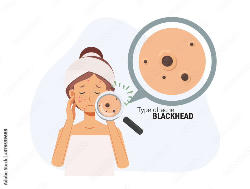 treat acne,skin problem,pimple.woman face.Type of acne blackhead.Flat vector 2d cartoon character illustration. Before, after