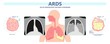 Acute respiratory distress syndrome (ARDS) a respiratory failure and inflammation in the lungs equipment hospital Emphysema fibrosis idiopathic Cystic Collapsed pneumothorax embolism X-Ray chest ICU