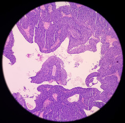 Wall Mural - Urinary bladder cancer: microphotograph transitional cell carcinoma, high grade, malignant neoplasm, Urinary bladder tumor, 40x view