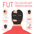 © Derariad - FUT hair transplantation process vector isolated. Follicular unit transplantation. Baldness problem, surgical treatment. Graft implantation, medical infographic.