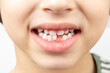 © ansyvan - Child mouth without one bottom front tooth
