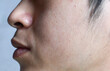 © ZAY WIN HTAI - Fair skin with wide pores in hairy face of Asian, Myanmar or Korean man.