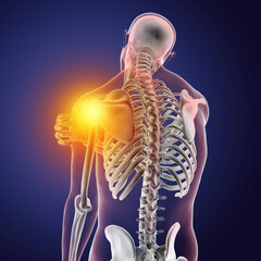 Poster - Shoulder pain, 3D illustration