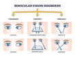 Binocular vision disorders with all eye defect examples outline diagram. Labeled educational anatomical strabismus, vergence and amblyopia division vector illustration. Medical sight health problems.