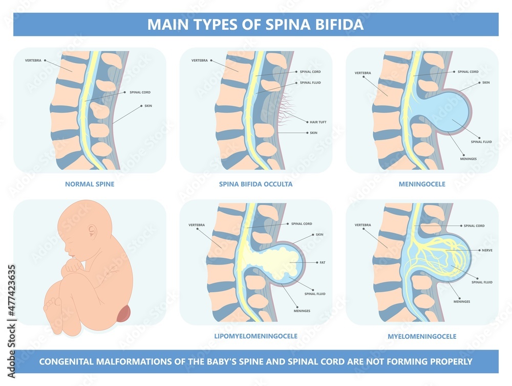Spina bifida Pregnancy non invasive neural tube gene AFP NTD infant ...