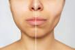 © Марина Демешко - Cropped shot of young caucasian woman before and after plastic surgery buccal fat pad removal on a white background. A lower part of face with clear highlighted cheekbones. Result of cosmetic surgery