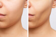 © Марина Демешко - Cropped shot of young caucasian woman before and after plastic surgery buccal fat pad removal on a white background. Result of cosmetic surgery. Cosmetology concept