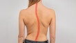 Woman with scoliosis of the spine. Curved woman's back.
