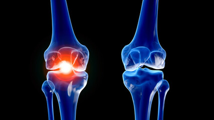 3d rendered illustration of a painful knee joint