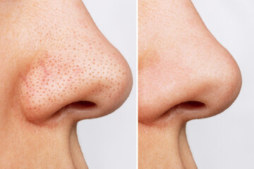 Wall Mural - Close-up of woman's nose with blackheads or black dots before and after peeling and cleansing the face isolated on a white background. Acne problem, comedones. Difference after the cosmetic procedure