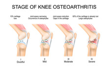 Knee Osteoarthritis Stages