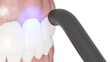 3d rendered illustration of a dental bonding process
