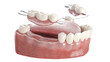 3d rendered illustration of a denture